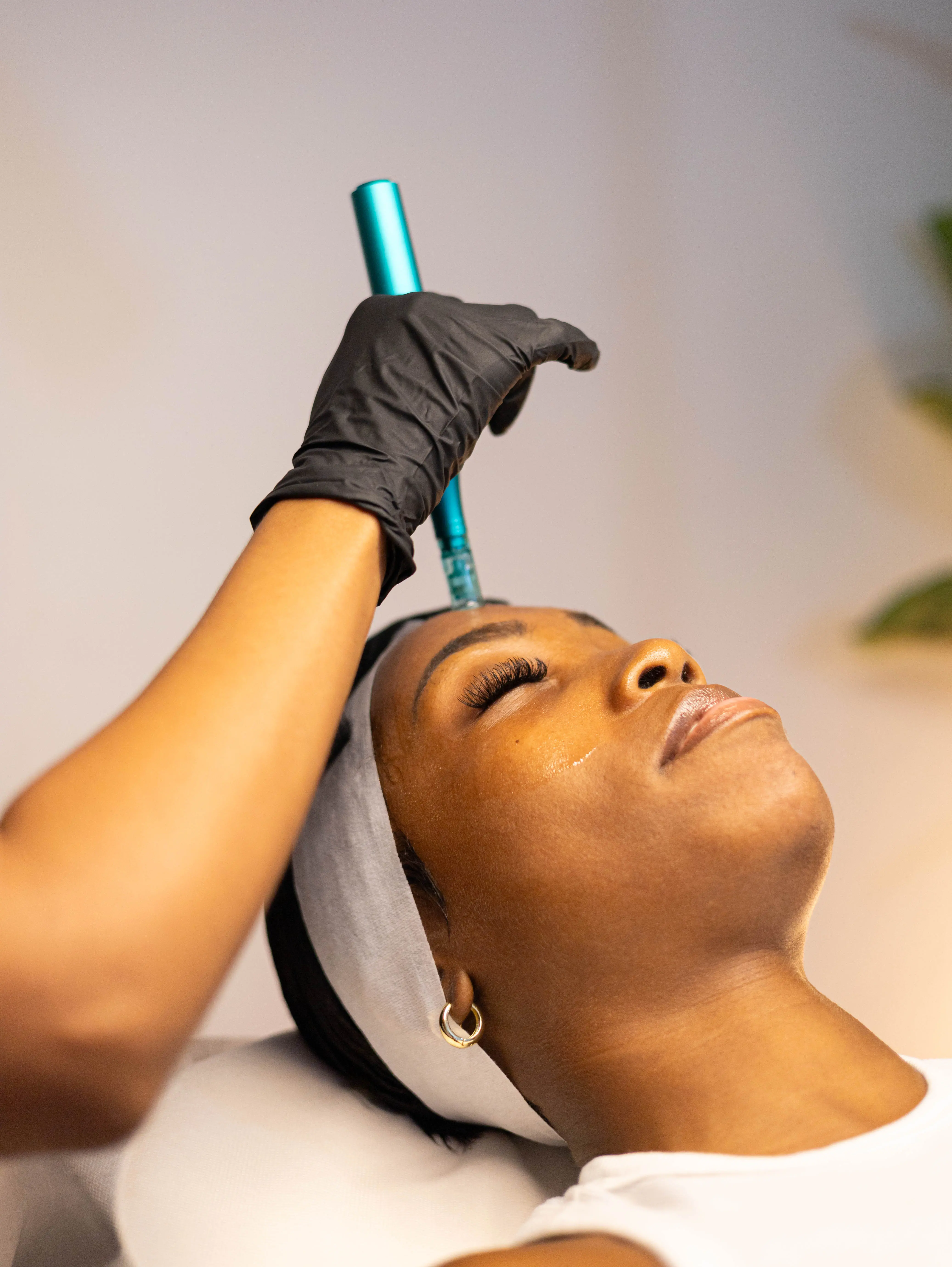 Microneedling Treatment